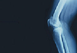 Prolotherapy Strengthens Weakened Tendons & Ligaments